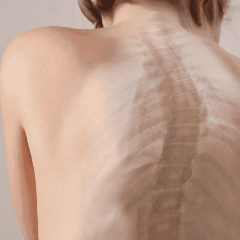Kyphosis