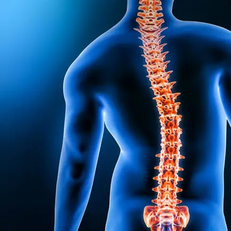 Scoliosis